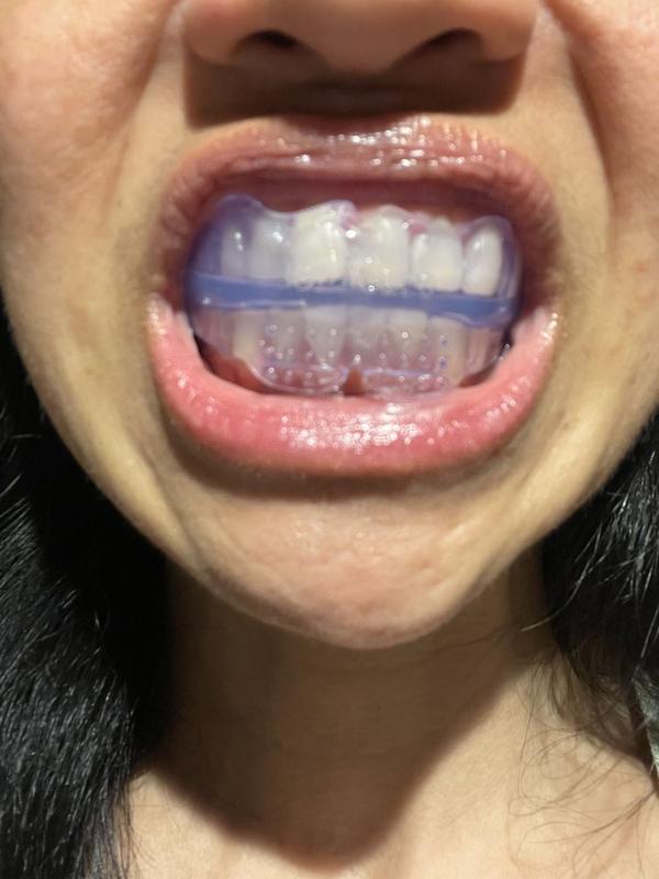 Adult Orthodontic Teeth Straightener for Alignment and Grinding photo review