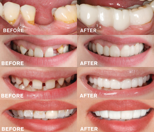 Magic Teeth Brace Veneer