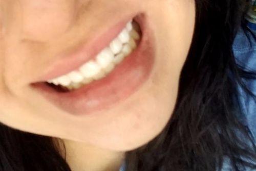 Magic Teeth Brace Veneer photo review