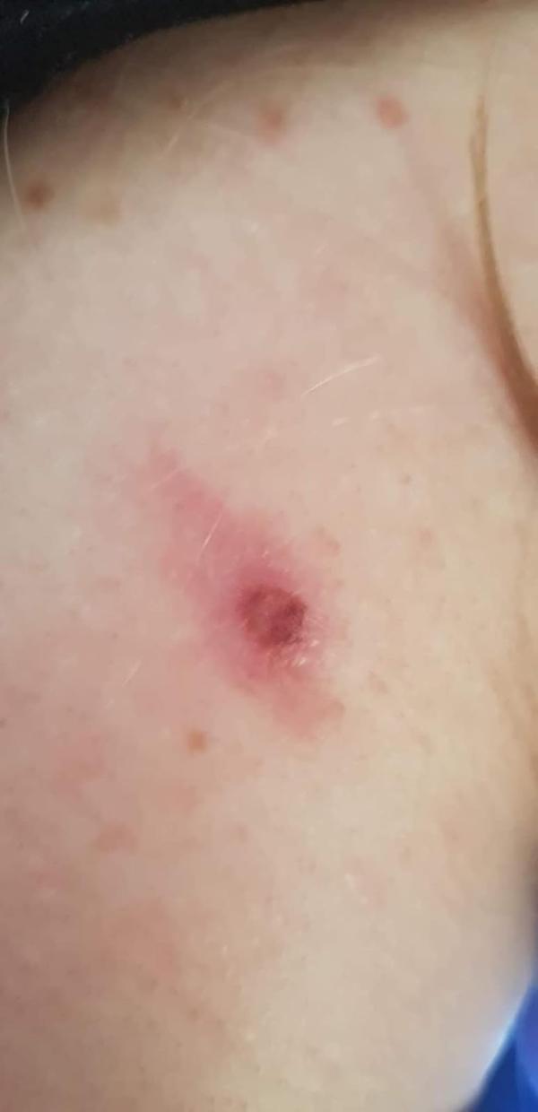 Mole Removal Plasma Pen photo review