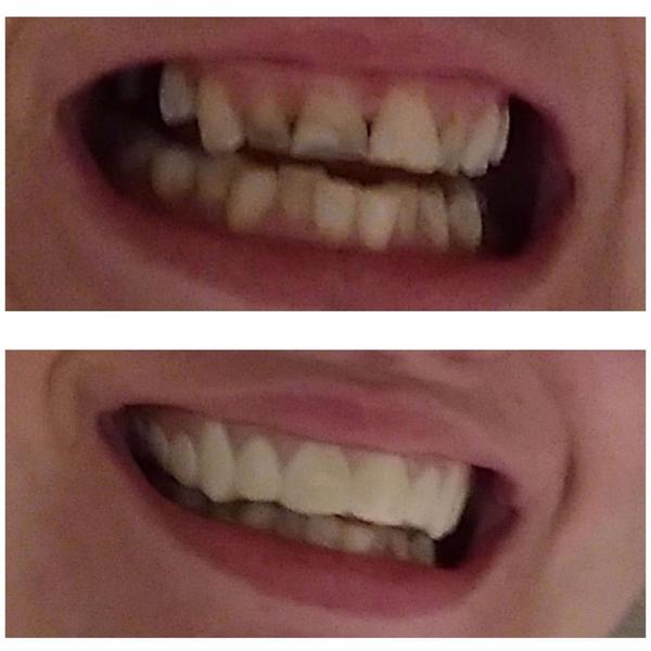 SmileGlo™ Teeth Veneer Silicone Top & Bottom photo review