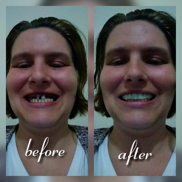 SmileGlo™ Teeth Veneer Silicone Top & Bottom photo review