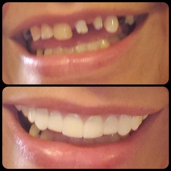 SmileGlo™ Teeth Veneer Silicone Top & Bottom photo review