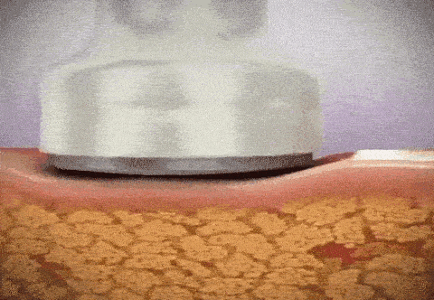 Ultrasonic Cavitation Machine With Anti Cellulite Cream