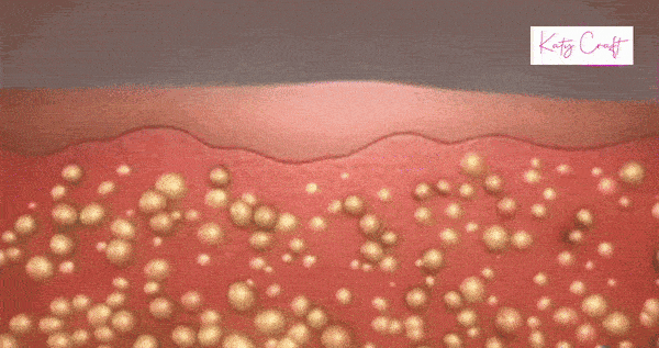 Ultrasonic Cavitation Machine With Anti Cellulite Cream