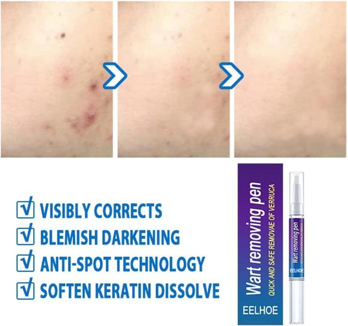 Wart Removal Pen for Skin Tags, Warts, and Corns - Natural Formula for Fast Healing