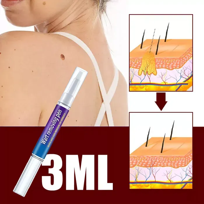 Wart Removal Pen for Skin Tags, Warts, and Corns - Natural Formula for Fast Healing